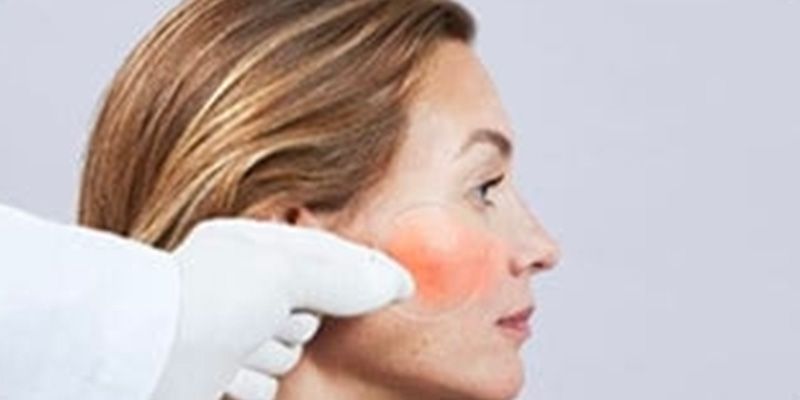 Couperose: cos’è, cause e trattamento per una pelle sensibile