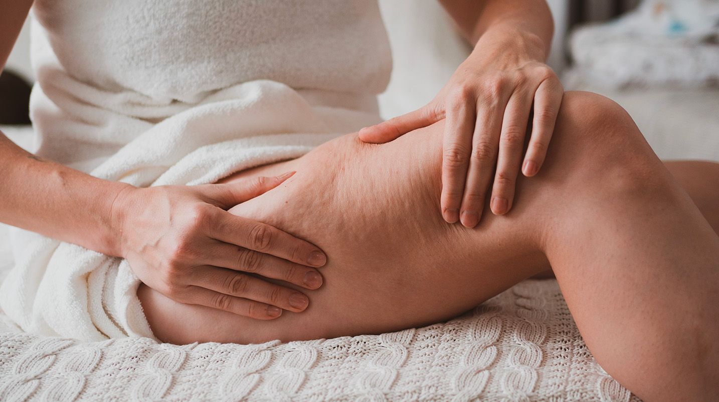 Lipedema: sintomi, cause e trattamenti