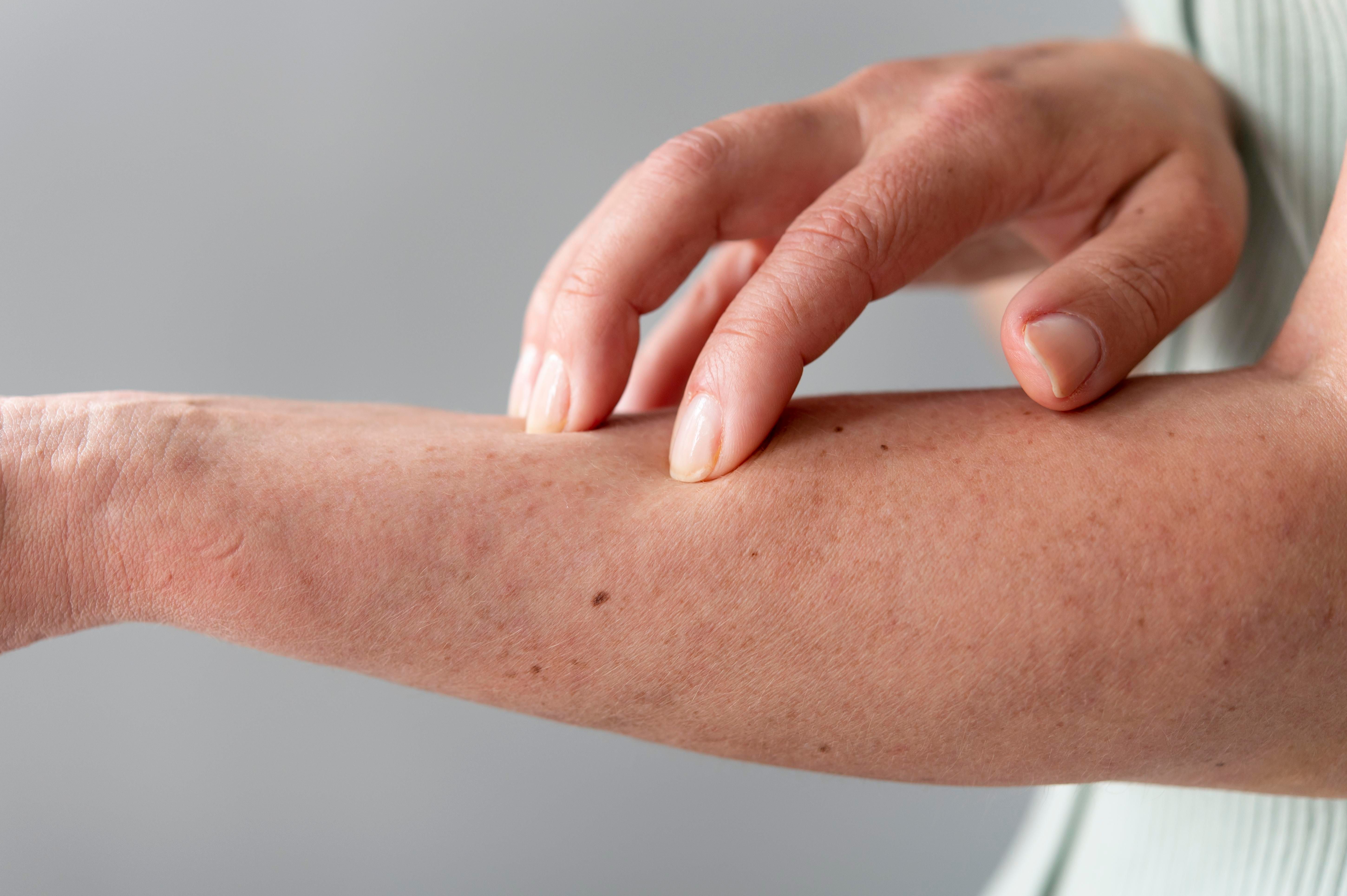 Orticaria da stress: come identificarla e quali rimedi usare